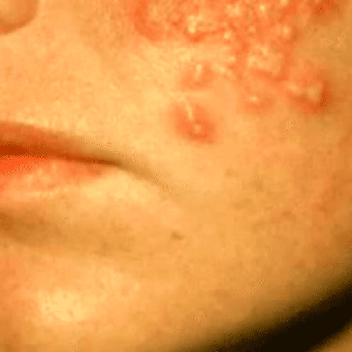 Hiv Rashes On Face