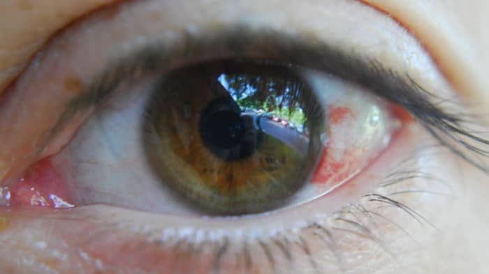 Subconjunctival Hemorrhage Broken Blood Vessels In The Eye HubPages