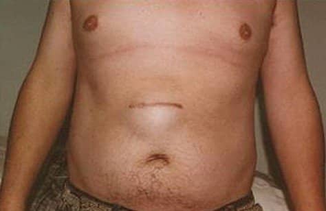 Pictures Symptoms Treatment Causes Of Epigastric Hernia Hubpages