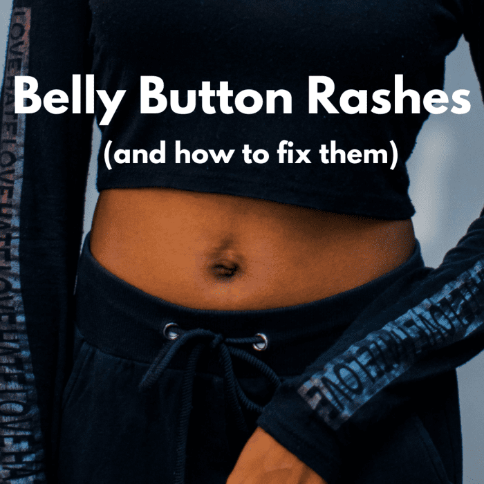 Rash Around The Belly Button Common Causes And Treatment HubPages