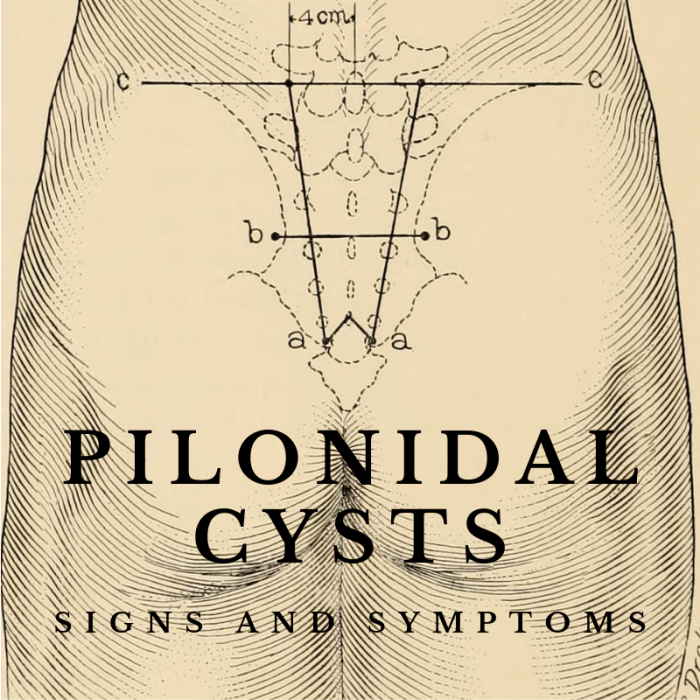 Hard Painful Bump On Your Tailbone Symptoms Of A Pilonidal Cyst 57960 ...