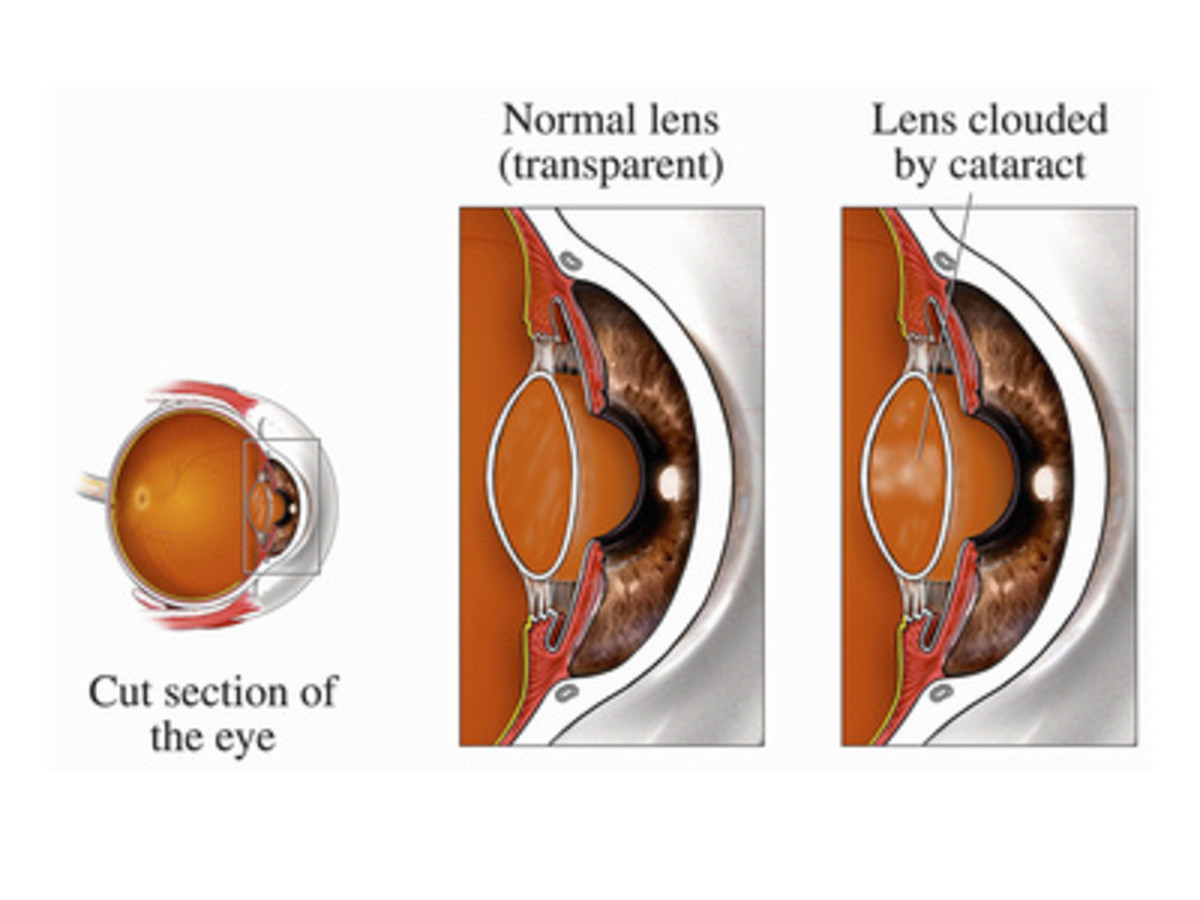 What To Expect Before During And After Cataract Surgery Patient S