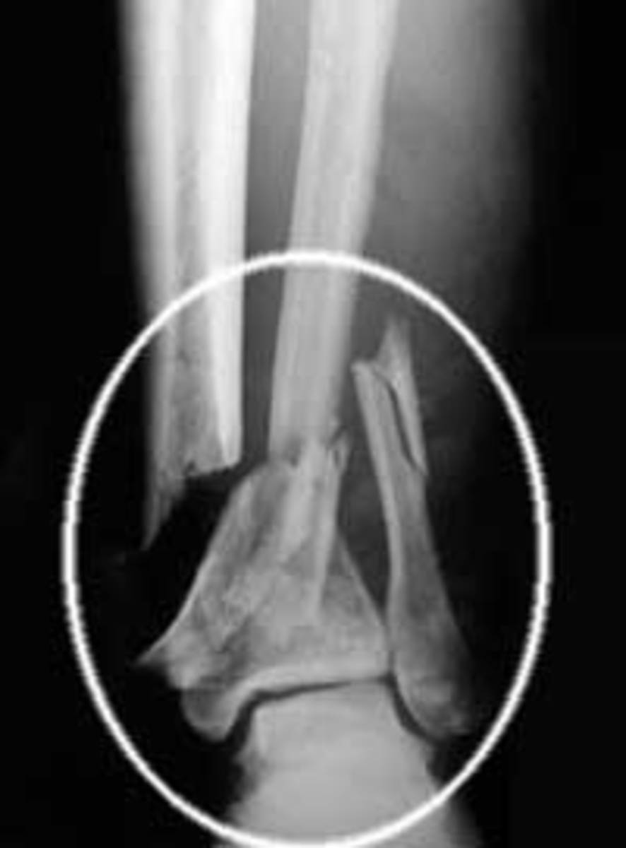 Broken ankle blue image