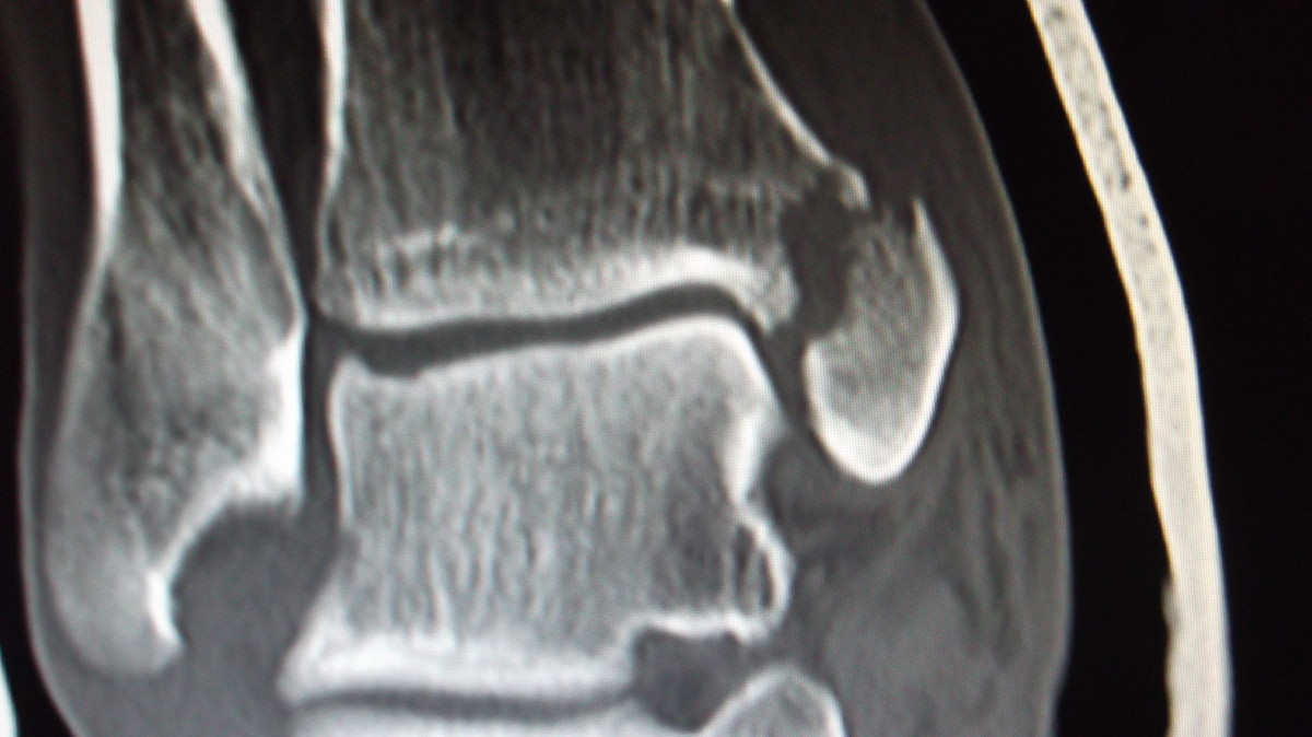 Broken Ankle Xrays With Plate And Screws Hubpages