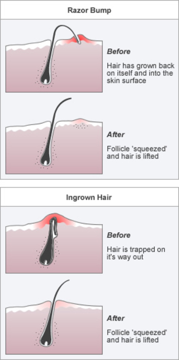 Infected ingrown bikini hair