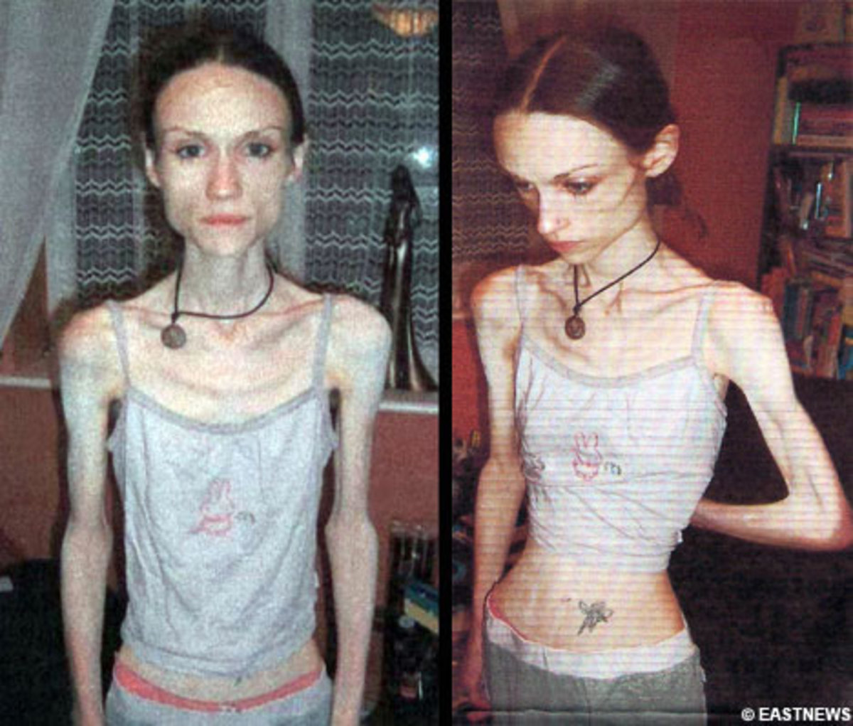 Eating Disorders Anorexia And Bulimia Hubpages
