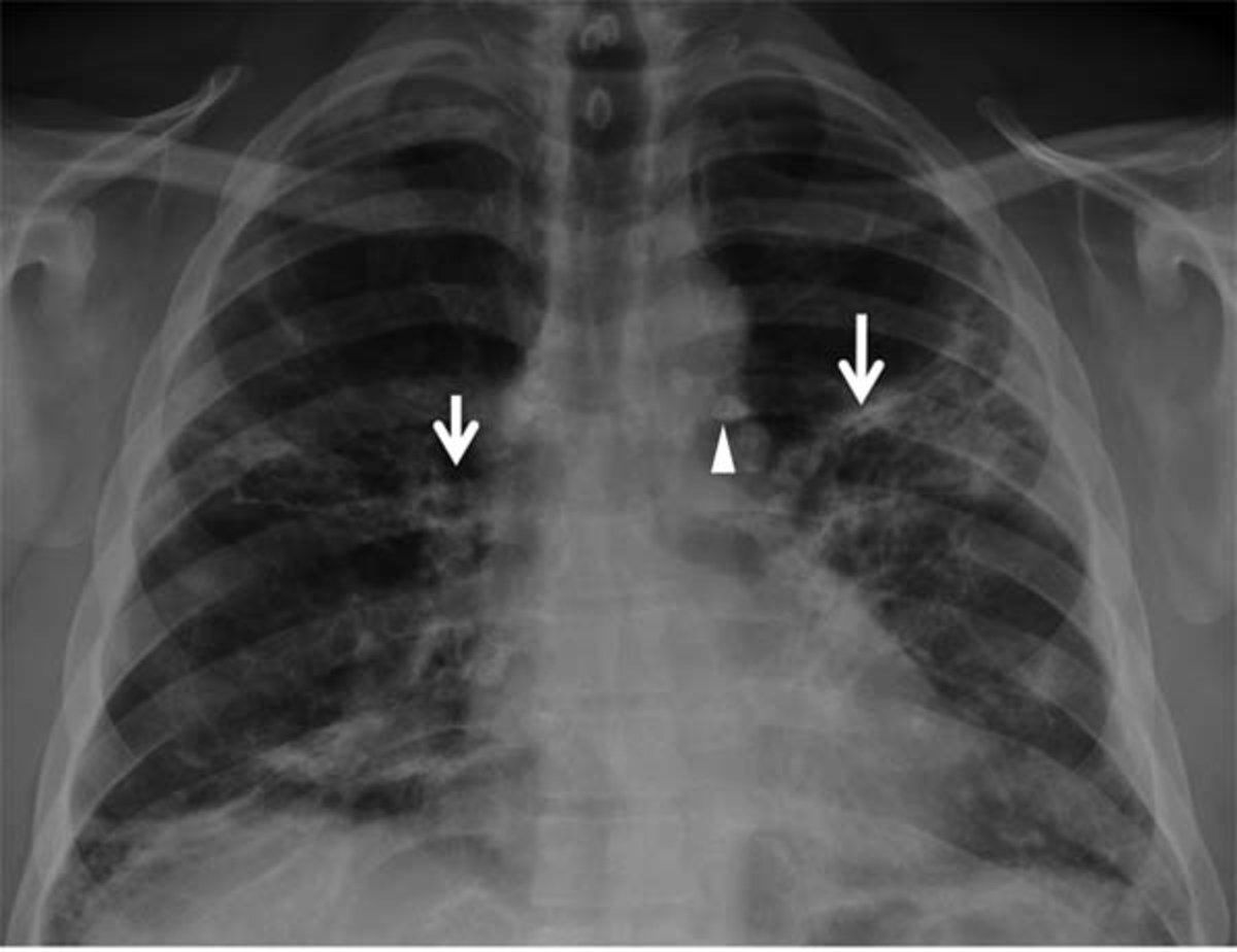 Флюорография органов грудной клетки туберкулез