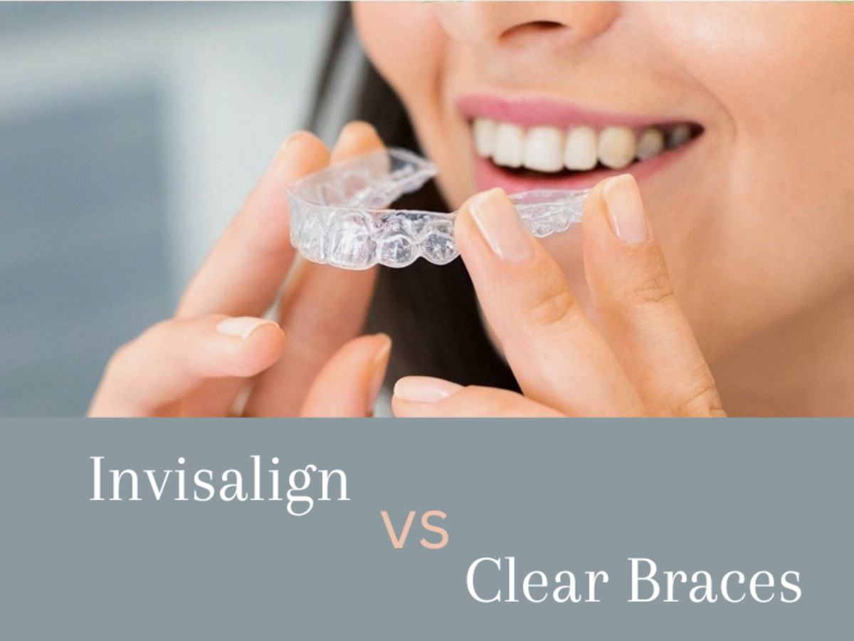 Invisalign Vs Clear Braces Pros And Cons YouMeMindBody