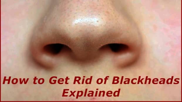how-to-get-rid-of-blackheads-explained