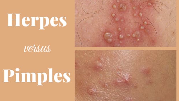 what-does-herpes-look-like-does-herpes-look-like-a-pimple