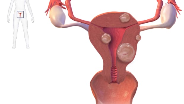 uterinefibroidsmyomectomysurgery