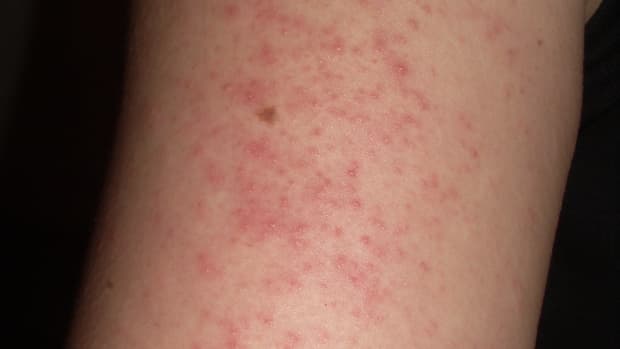 skin-rash-on-legs-quick-tips-for-cure