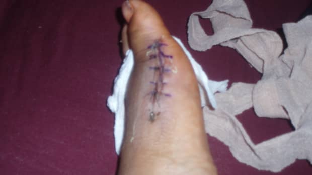 my-bunion-surgery-after-6-months-of-recovery