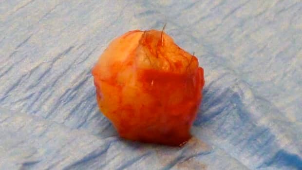 this-is-what-a-cyst-looks-like