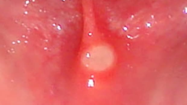 how-to-get-rid-of-canker-sores