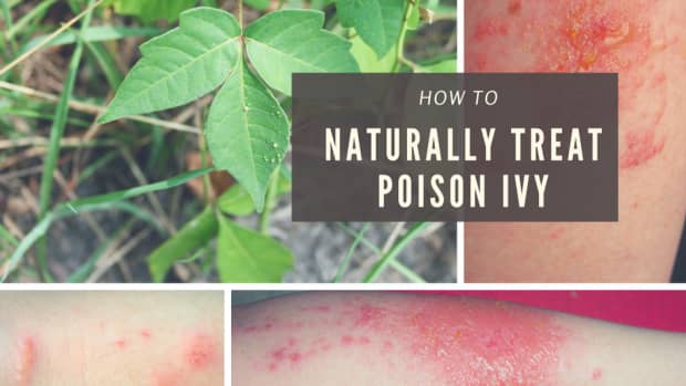 natural-cure-to-poison-ivy