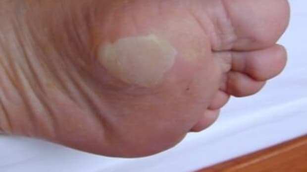 blister-treatment-causes-and-care