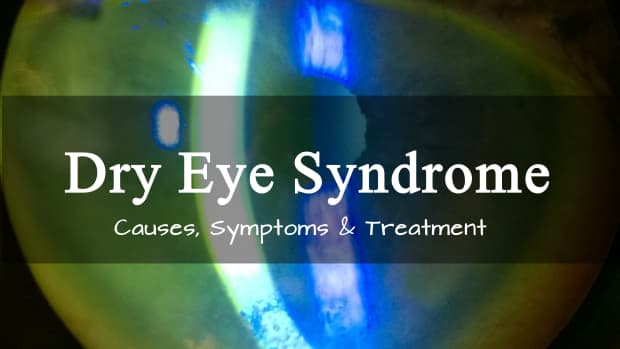 dry-eye-syndrome-symptoms-and-treatment-of-dry-eye