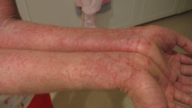 how-to-get-rid-of-eczema-fast