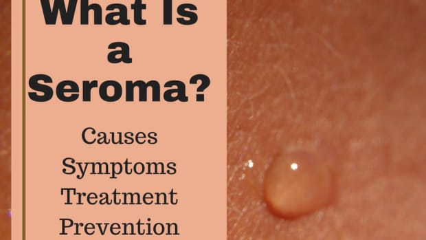 seroma-causes-symptoms-treatment-and-prevention