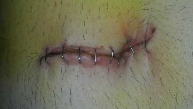 recovering-from-laparoscopic-surgery