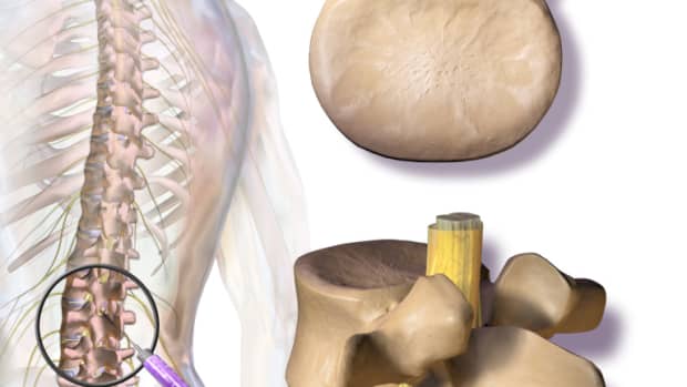 lumbarcervical-epidural-steroid-injections-a-treatment-for-pain-related-to-disc-disease