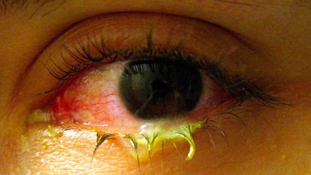 what-is-pink-eye-causes-symptoms-and-treatment