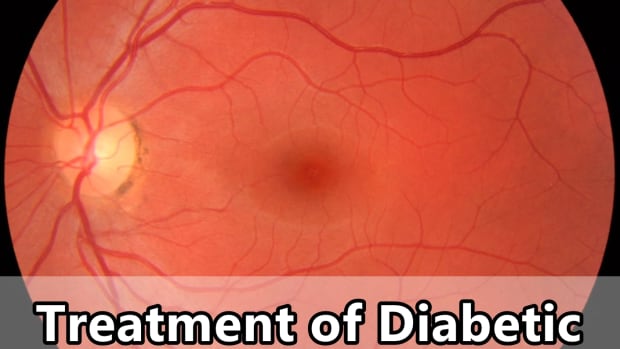 treatment-of-diabetic-retinopathy