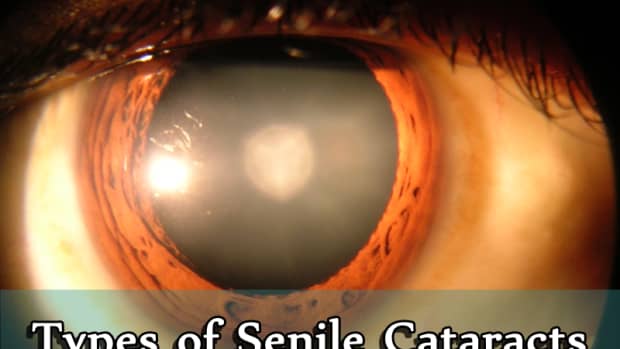 types-of-senile-cataracts