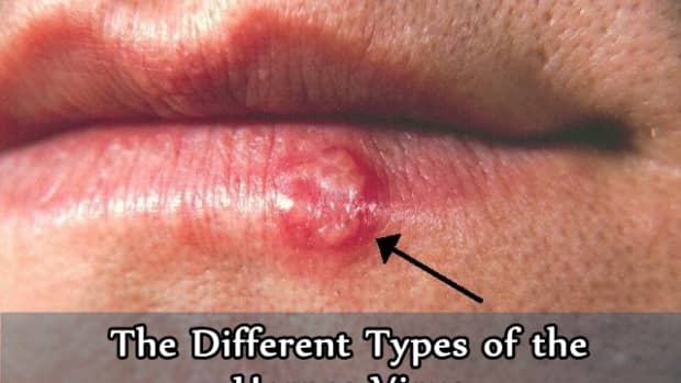 the-different-types-of-the-herpes-virus