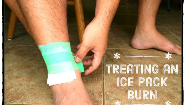 how-to-treat-a-cold-pack-burn