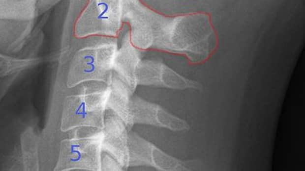 causes-symptoms-and-treatment-of-cervical-neck-osteoarthritis