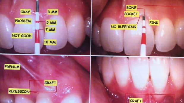 what-its-like-to-get-gum-grafting-surgery