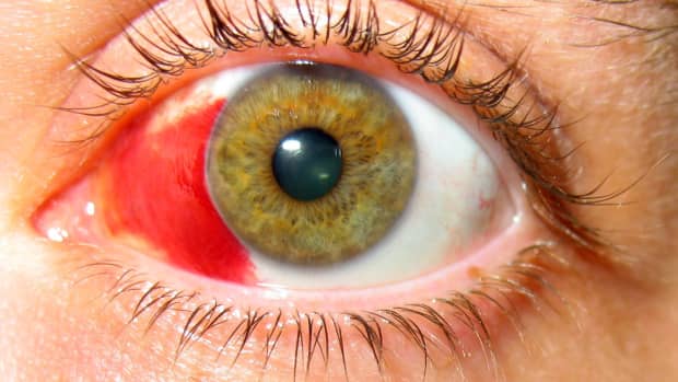 healing-broken-blood-vessels-in-the-eye