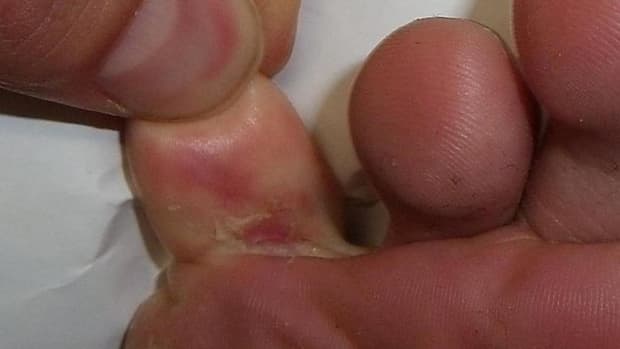 how-to-cure-foot-fungus