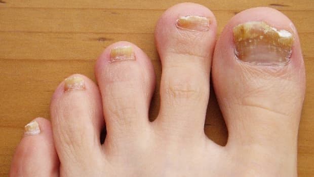 nail-fungal-infection