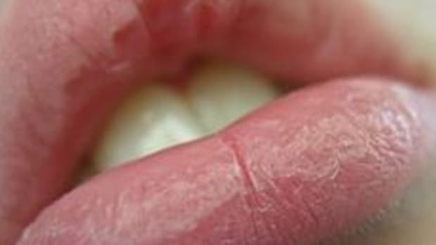 11-natural-ways-to-cure-dry-chapped-cracked-and-peeling-lips-with-homemade-remedies