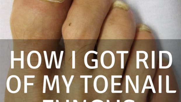 how-i-cured-fungal-toes-or-onycholysis