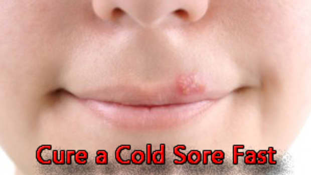 the-best-way-to-get-rid-of-a-cold-sore-remedies-for-every-stage