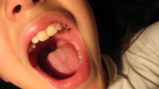 possible-causes-of-bump-on-roof-of-mouth