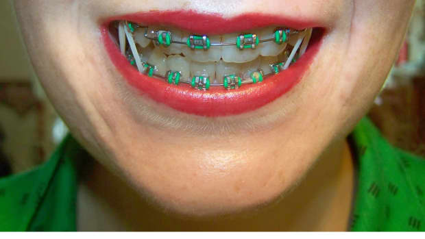 tips-and-advice-for-anyone-with-braces
