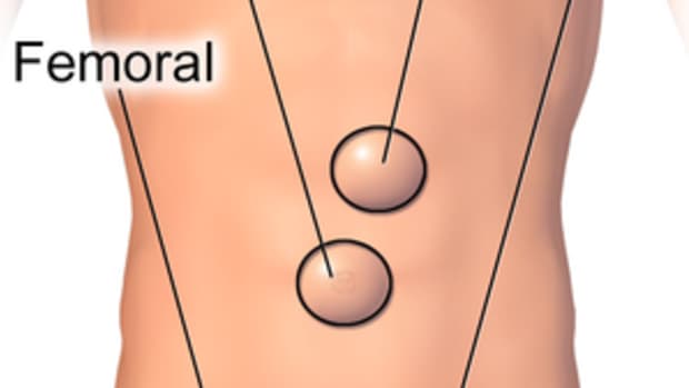 femoral-hernia