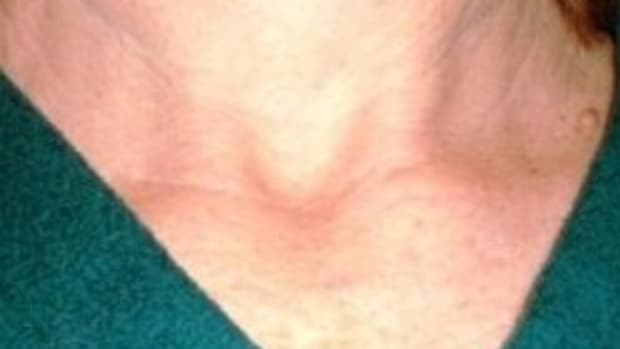 thyroid-cancer-information