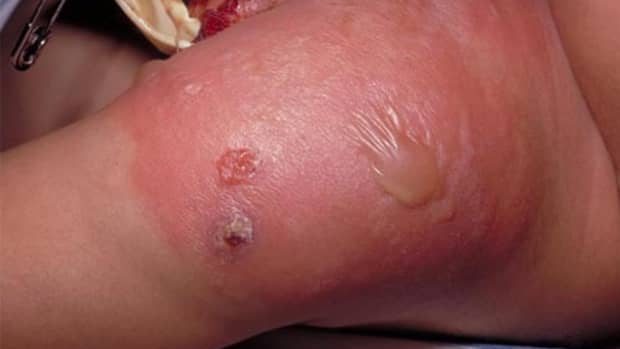 secondary staphylococcal infection at the smallpox vaccination site