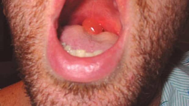 swollen-uvula