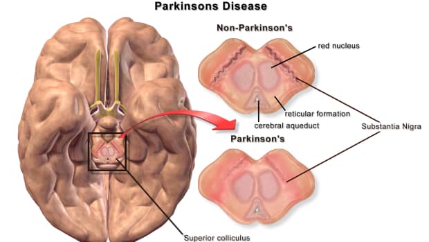 the-digestive-tract-and-parkinsons-disease-a-possible-link