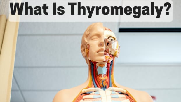 thyromegaly