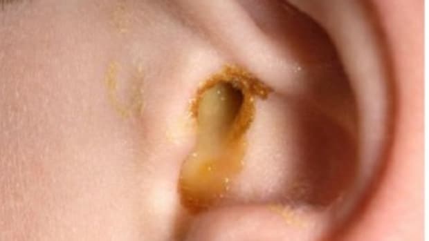 ear-infection-prevention-and-cure