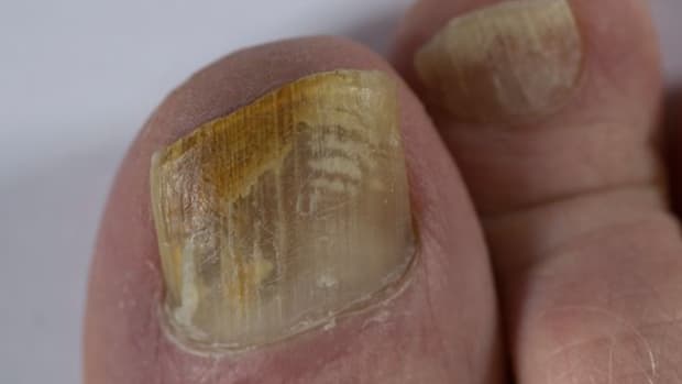 how-to-treat-a-fungal-nail-infection-using-tea-tree-oil
