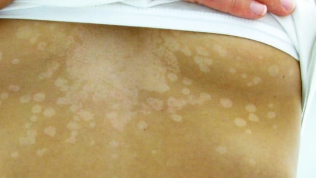 white-patches-and-spots-that-wont-tan-dark-patches-on-back-and-shoulders-tinea-versicolor-can-easily-be-treated